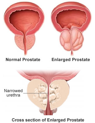prostate